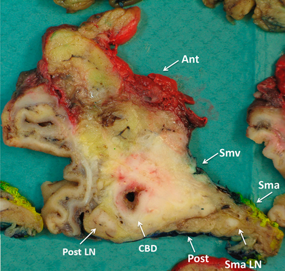 Figur 8: Aksiale disseksjonsskiver tillater enkel identifisering av anatomiske strukturer og pancreasoverflater.