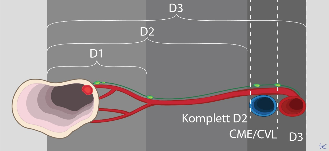 Figur 4: Tverrsnitt av karanatomien ved høyre hemikolektomi. Komplett D2 er disseksjon helt inntil høyre kant av vena mesenterica inferior. CME/CML omfatter disseksjon til høyre kant av arteria mesenterica superior, mens D3 omfatter disseksjon semisirkulært på arteria mesenterica superior.