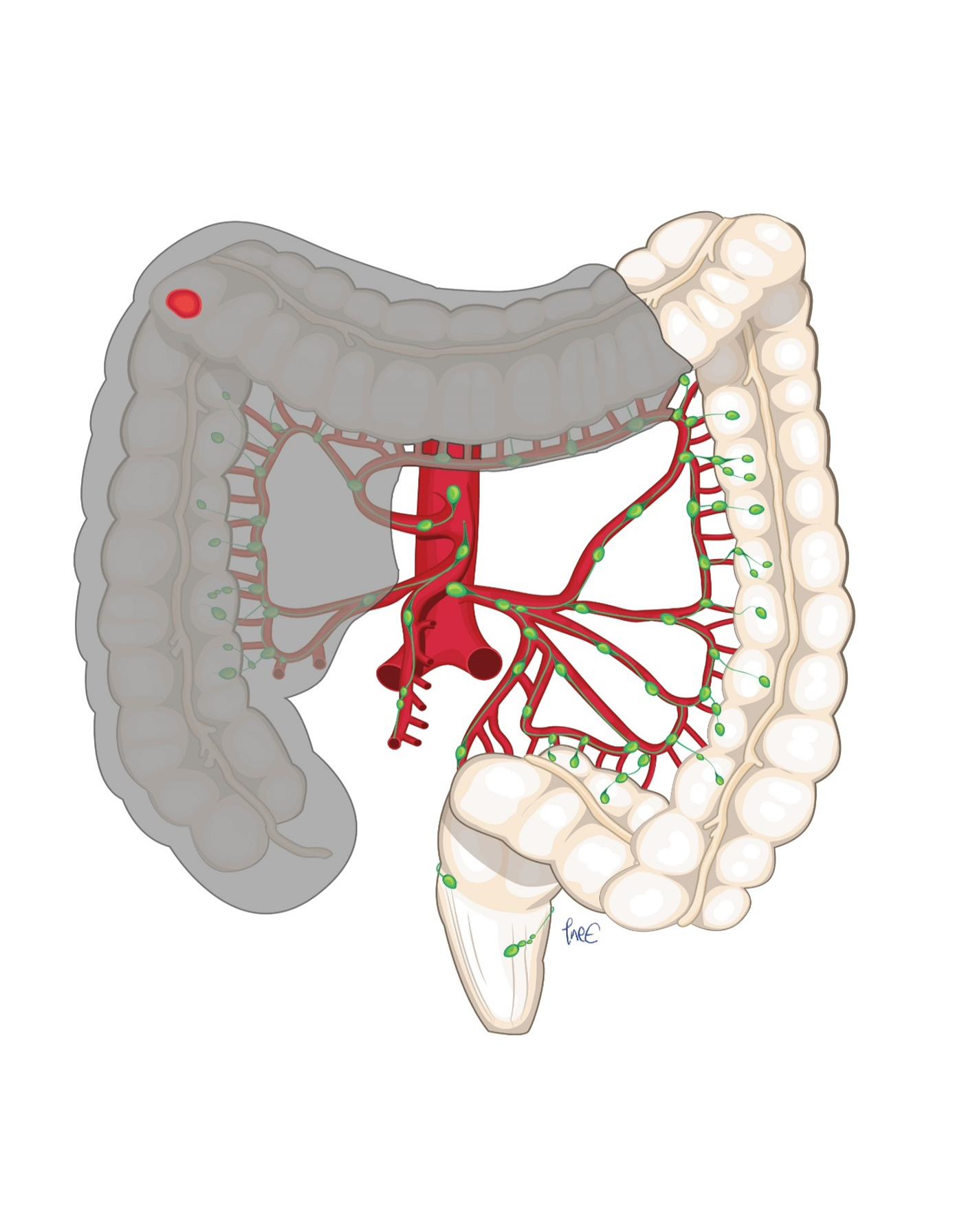 Figur 5: Cancer i høyre fleksur. Utvidet høyresidig hemikolektomi med deling av arteria ileocolica og arteria colica media ved origo.