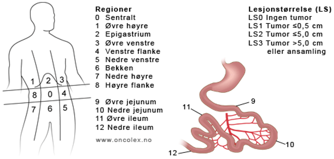 Tykk og endetarmskreft - Regioner og score til bruk ved utregning av Peritoneal Carcinomatosis Index.png