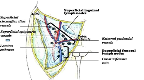 Figur 8.4: Illustrasjon av beliggenheten til de superficielle inguinofemorale lymfeknutene i relasjon til Scarpa’s triangle og den femorale fascie. De dype femorale lymfeknutene er ikke synlige (dekket av lamina cribrosa). (Fra Micheletti et al 2006, s 18 (Micheletti et al., 2005)).