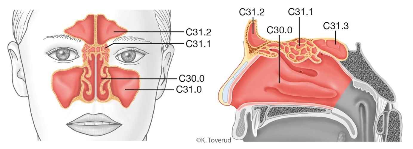 Figur 14.1: Anatomi Nese og bihuler. Nesen omfatter C30.0 cavum nasi med septum (neseskillevegg), conchae nasalis (nesemuslinger) og laterale nesevegg. C31.2 sinus frontalis; C31.1 sinus ethmoidalis; C31.0 sinus maxillaris; C31.3 sinus sphenoidalis