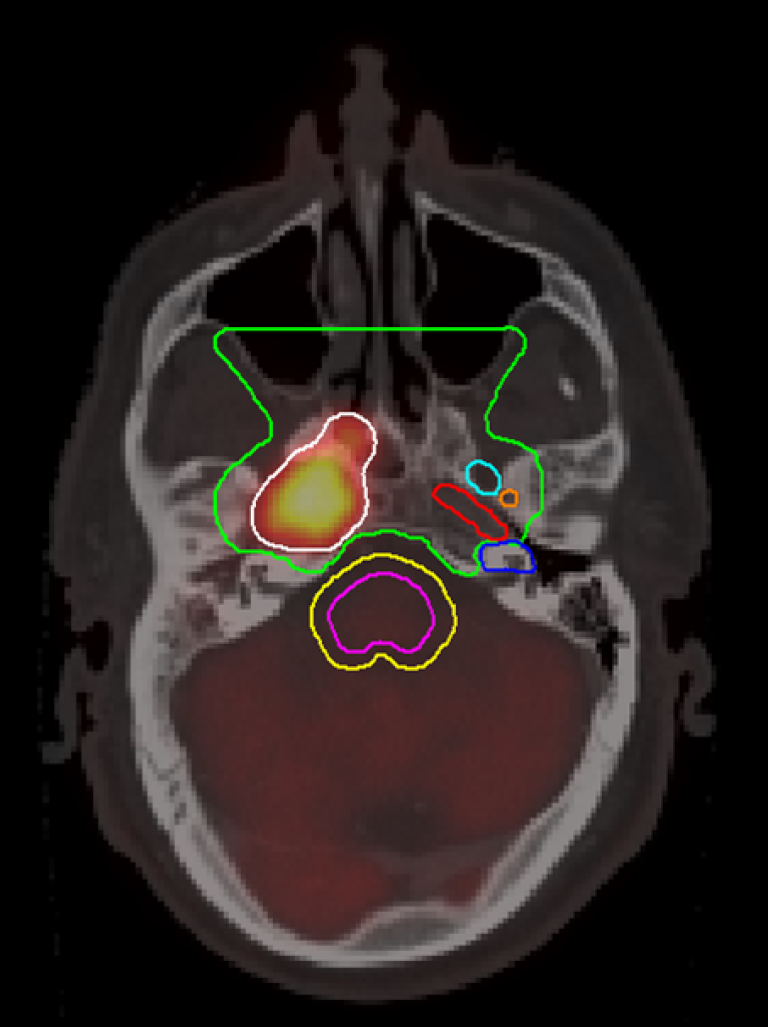 Figur 15.4: CTV3 nasofarynks , foramen ovale, foramen spinosum, carotis kanal, cochlea, hjernestamme, PRV hjernestamme. Gjennomvekst av primærtumor gjennom carotis kanal på høyre side.