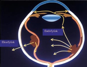 Figur 2: Illustrasjon av endofytisk og eksofytisk retinoblastomvekst