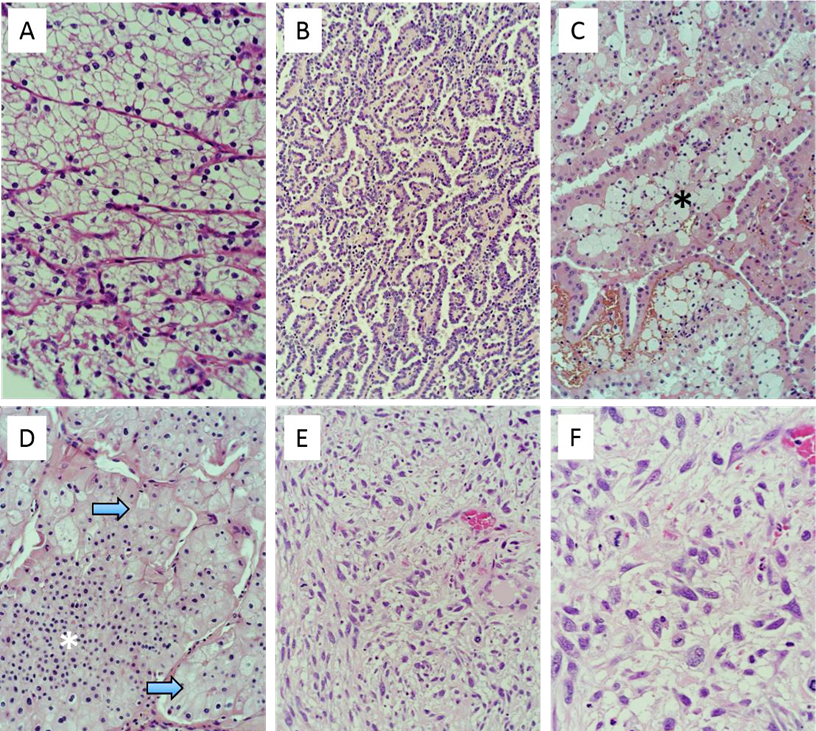Figur 6.1: Morfologisk bilde av de hyppigst forekommende nyrecellekarsinomer (Regionalt cancercentrum, 2019)