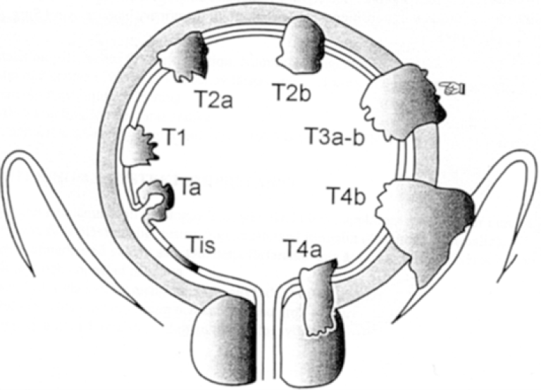Figur 4: T-stadium, blærekreft Hentet fra TNM Classification of Malignant Tumours, 7. utg. (Sobin et al., 2010) Copyright 2010 Wiley-Blackwell. Gjengitt med tillatelse 2025. 