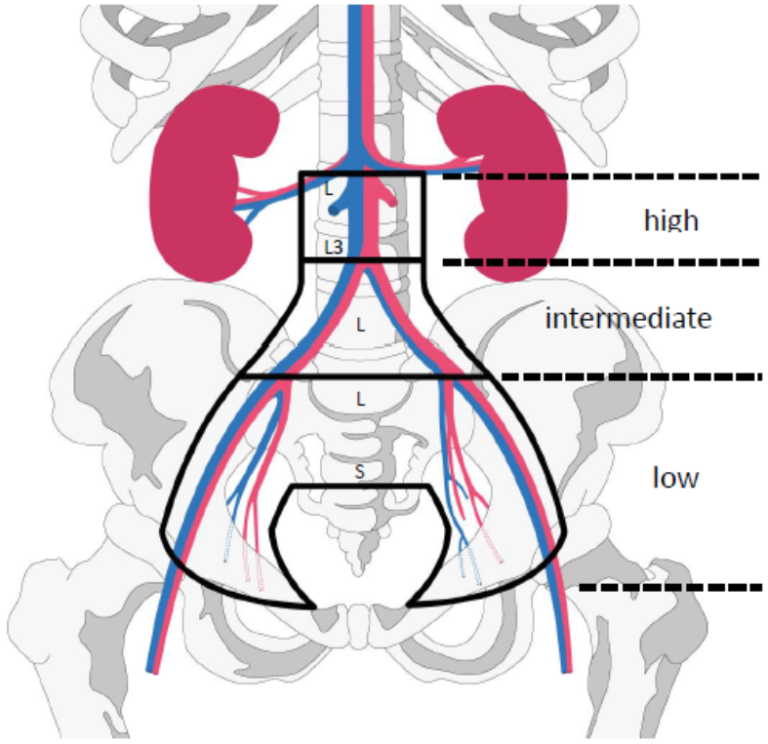 Gynekologisk kreft - Skjematisk diagram av risikogrupper.png