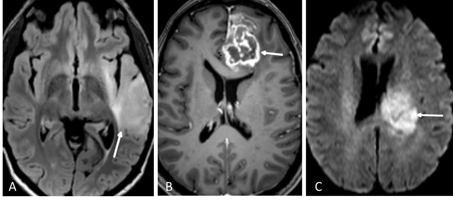 Figur 5.1: FLAIR-bilde til venstre viser diffust infiltrerende lavgradig gliom (pil). I midten sees et T1-vektet bilde som viser uregelmessig kontrastoppladning i glioblastom (pil). Til høyre et diffusjonsvektet bilde som viser redusert diffusjon (lyst signal) i høygradig hjernesvulst som tegn på høy celletetthet (pil).