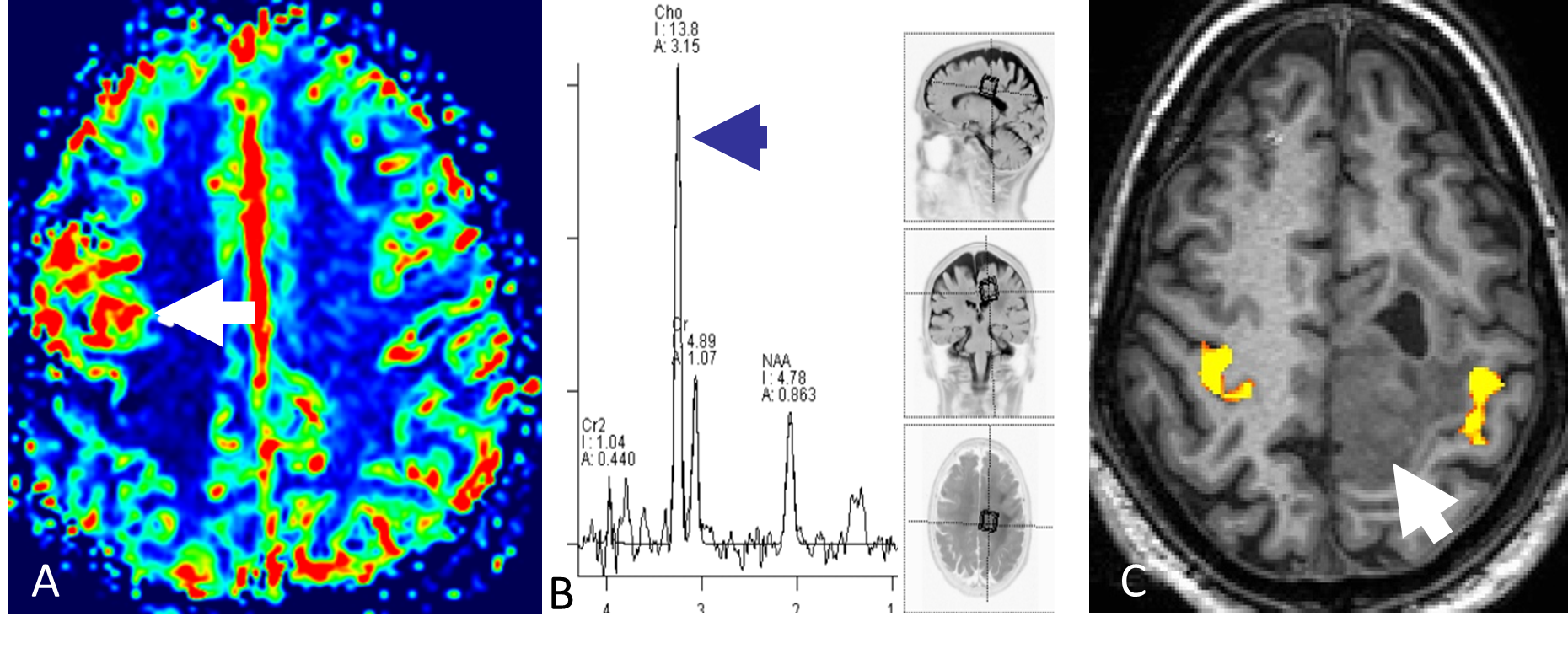 Figur 5.2: Bildet til venstre viser undersøkelse med MR-perfusjon hvor man ser høyt blodvolum i malign hjernesvulst (pil). I midten MR-spektroskopi av hjernemetastase som viser høy mengde av metabolitten cholin (pil). Til høyre fMRI som viser kortikal aktivering (gulrød farge) ved fingerbevegelser i motorisk område nær et lavgradig diffust gliom (pil).