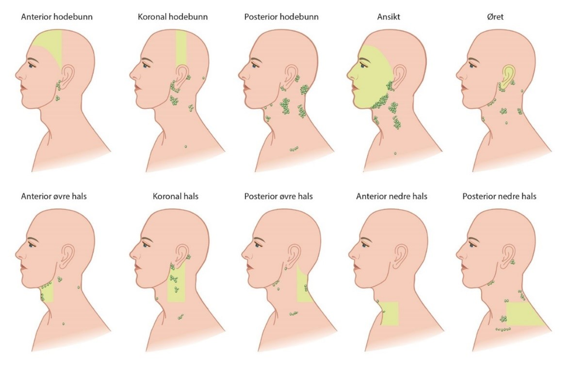 Figur 22.2: Lymfedrenasje fra hud i hode og hals til primære lymfeknutenivåer på halsen