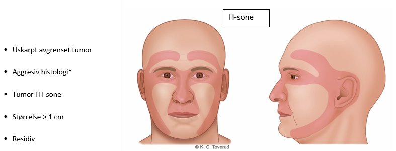 Figur 22.3 Basalcellekarsinom, risiko for residiv. Ansiktets H-sone