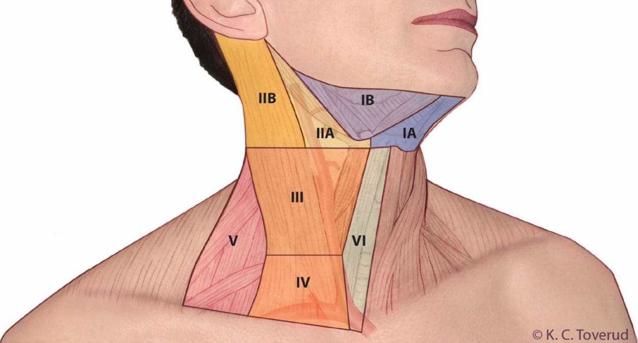 Figur 9.1: Lymfeknuteregioner på halsen, regio I – VI.