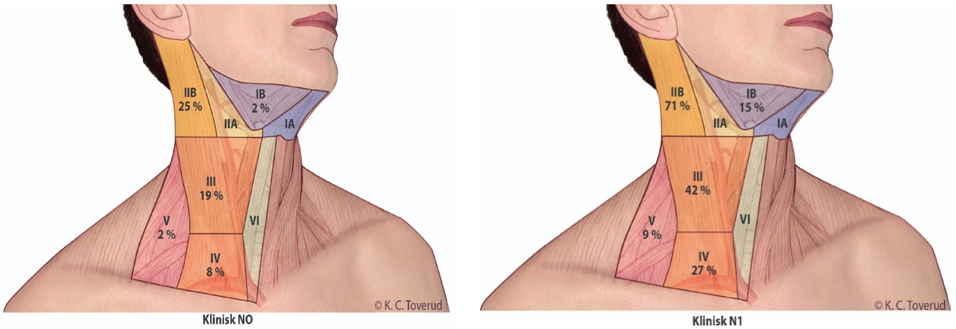 Figur 17.3 Prosentvis fordeling av lymfeknutemetastaser ved kreft i orofarynks (Candela et al., 1990)