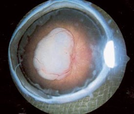 Figur 1: Enukleert øye med endofytisk retinoblastom