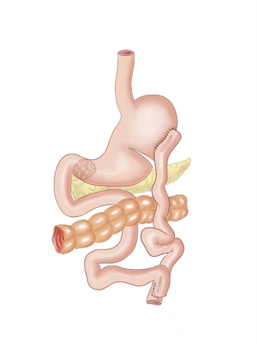 Figur 10: «Devine» gastroenterostomi. Illustrasjon: G. Al-Haidari. Gjengitt med tillatelse.