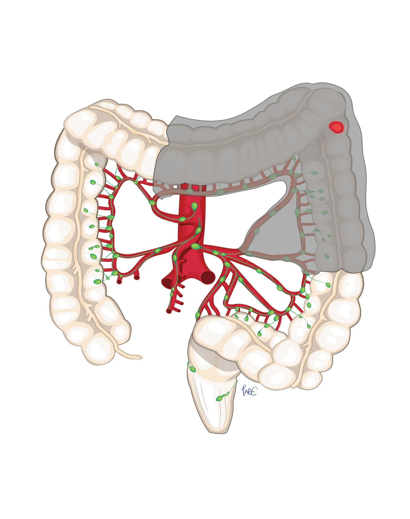Figur 7: Cancer i venstre fleksur med deling av arteria colica sinistra ved origo og venstre gren av arteria colica media.