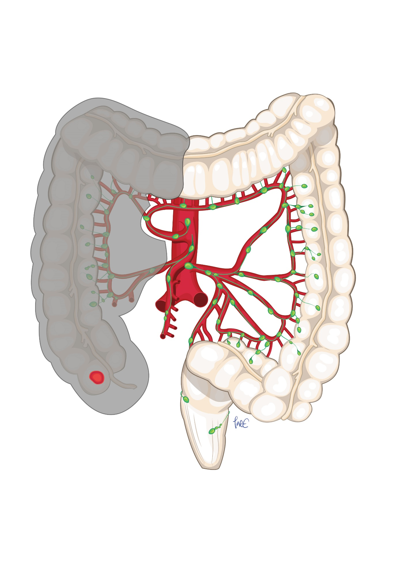Figur 2: Cancer i cøkum og høyre kolon. Høyresidig hemikolektomi med avsetning av høyre gren av arteria colica media ved origo og arteria ileocolica som D2 komplett disseksjon.