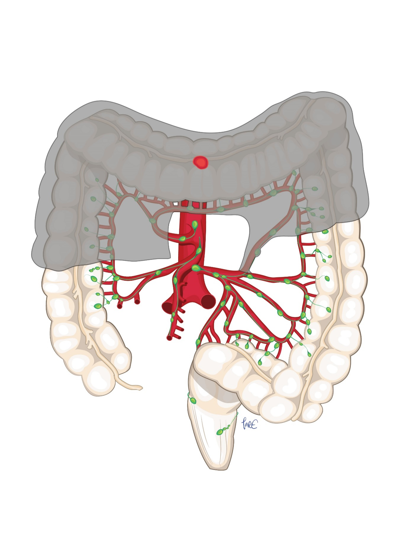 Figur 6: Cancer i kolon transversum med deling av arteria colica media sentralt og reseksjon av transversum med begge fleksurer.