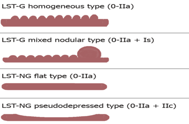 Figur 6.2: LST klassifikasjon (tilpasset fra Castillo-Regalado et al. (2022)Castillo-Regalado E, Uchima H., 2022, CC BY-NC 4.0) beskriver klassifikasjons-systemet for store flate/bredbasete polypper. (LST-G lateral spreading tumor-granular, LST-NG lateral spreading tumor-nongranular) 