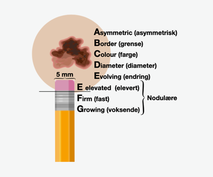 Figur 6.1: ABCD og EFG-regelen