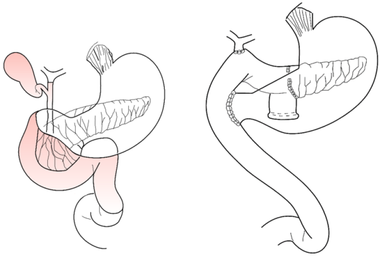 Figur 4: Pylorusbevarende pancreatoduodenectomi