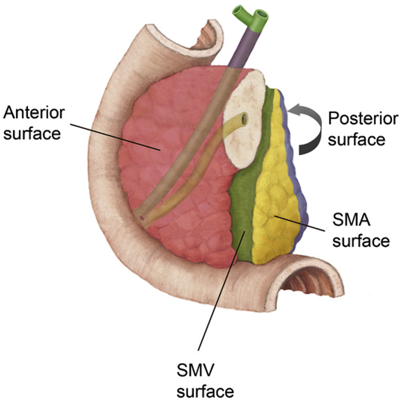 Pancreaskreft - Figur 5.png