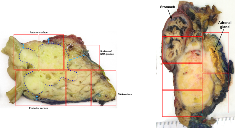 Figur 9: En-bloc snittuttak tillater optimal vurdering av tumors størrelse, relasjon til anatomiske strukturer og  reseksjonsrendene, og peripancreatiske lyfemknuter (til venstre: aksial skive fra et pancreatoduodenectomipreparat, til høyre: sagittal skive fra et utvidet distalt pancreasresektat inkl.  ventrikkelsegment og venstre binyre).